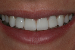 after2 after smile
