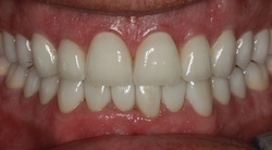 MILAM|JACK|A teeth