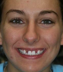 girl smiling with missing teeth