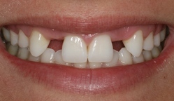 BAGLEY|LINDSEY| before photo smile missing teeth