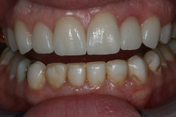 before3 yellow damaged teeth