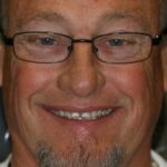 man smiling with damaged teeth