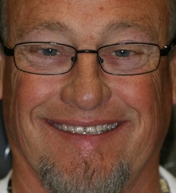 MILAM|JACK|A man smiling with damaged teeth