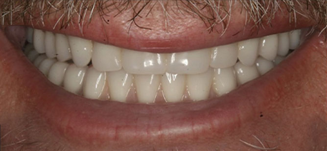 fixed teeth