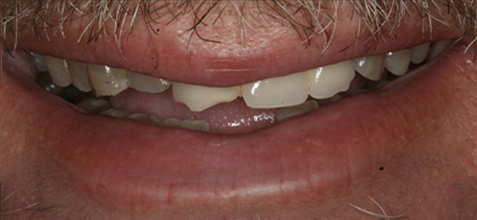 broken teeth